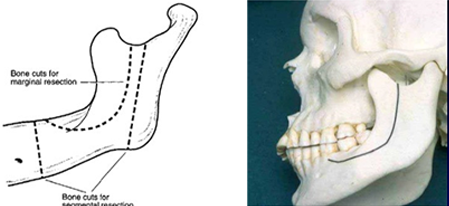 Jaw Bone Cancer